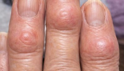 Hard Bumps on Finger Joints Near the Nails: What They Could Mean